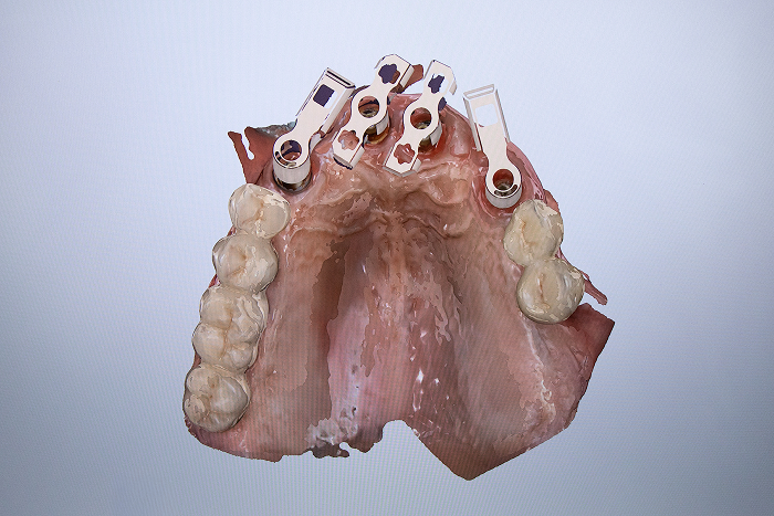 Modélisation 3D pour prothèse sur implant : scan flags positionnés pour la chirurgie implantaire