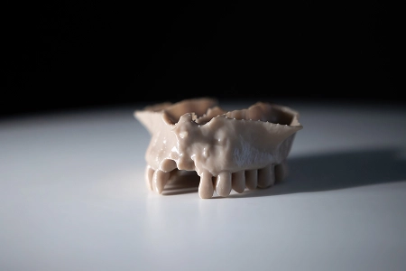 Planification de régénération osseuse guidée (ROG) sur modèle maxillaire imprimé en 3D