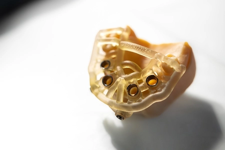 Chirurgie guidée en implantologie : guide chirurgical imprimé en 3D sur modèle